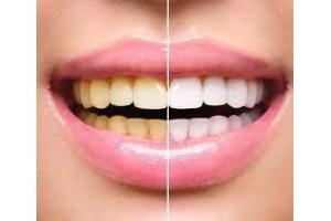 Clareador Dental com Carvão Ativado em Pó Natural origem Vegetal